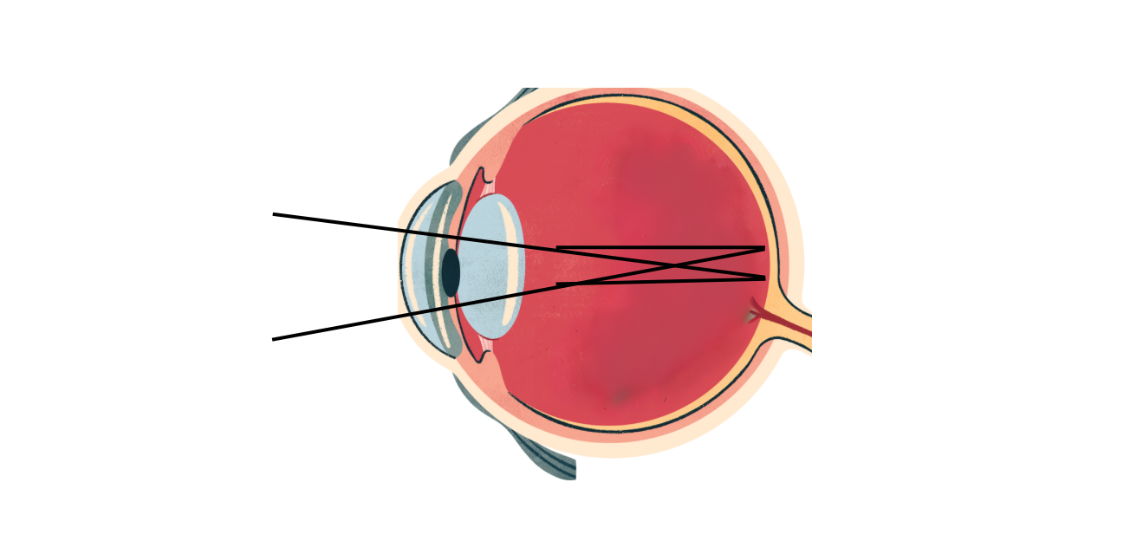 Astigmatism