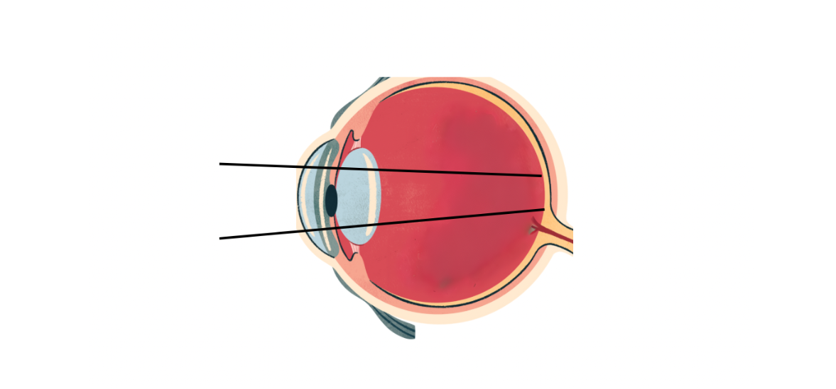 Presbyopia