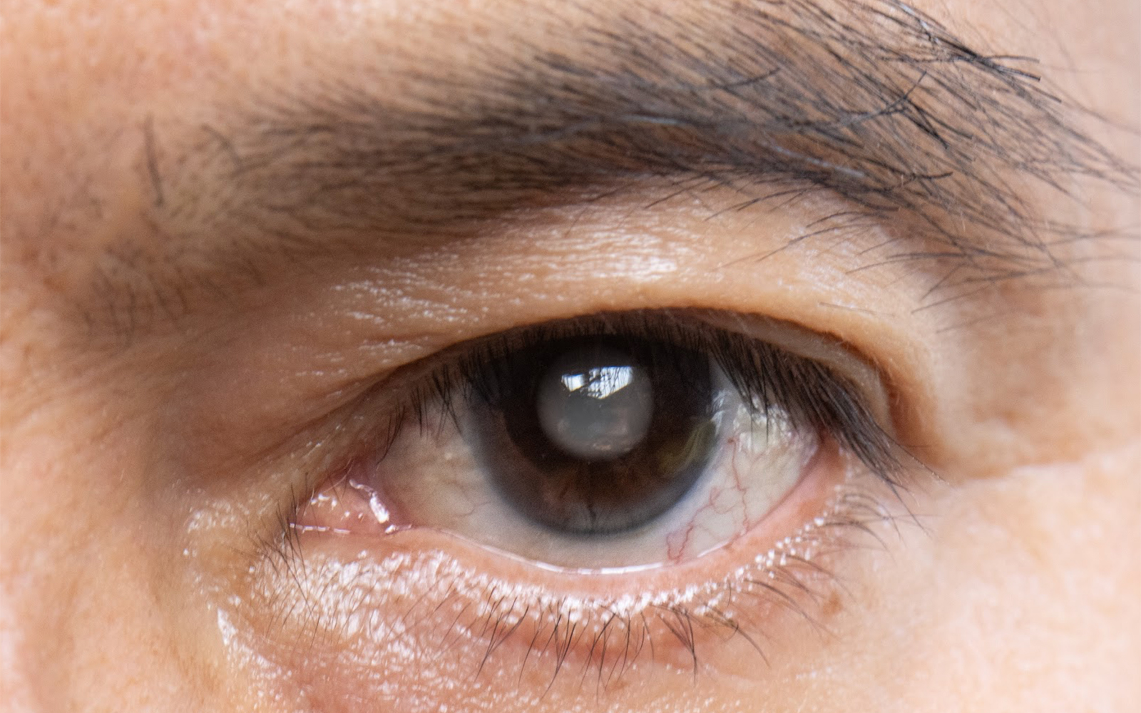 Closeup of Cataracts